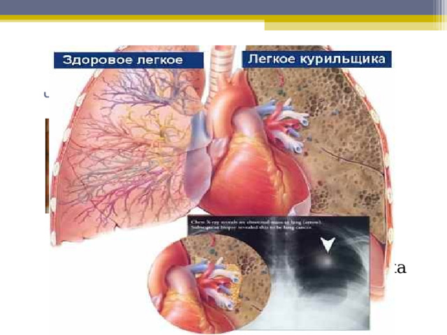  Изменения в легких курящего человека Легкие курящего Легкие здорового  человека человека 