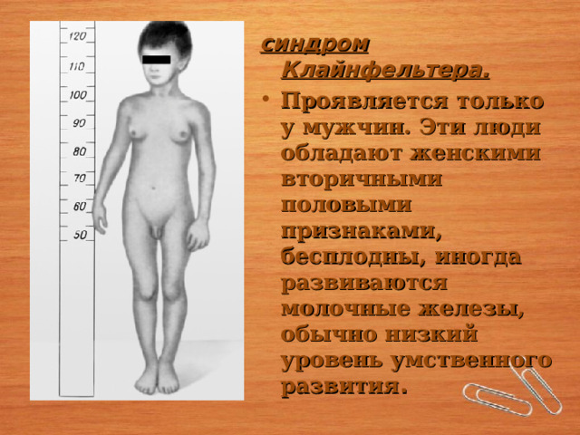 синдром Клайнфельтера. Проявляется только у мужчин. Эти люди обладают женскими вторичными половыми признаками, бесплодны, иногда развиваются молочные железы, обычно низкий уровень умственного развития . 