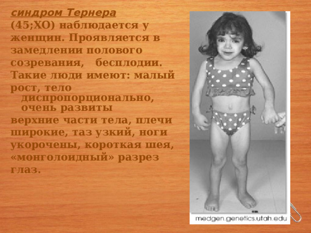 синдром Тернера (45;ХО) наблюдается у женщин. Проявляется в замедлении полового созревания, бесплодии. Такие люди имеют: малый рост, тело диспропорционально, очень развиты верхние части тела, плечи широкие, таз узкий, ноги укорочены, короткая шея, «монголоидный» разрез глаз. 