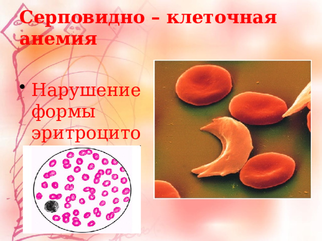 Серповидно – клеточная анемия Нарушение формы эритроцитов. 