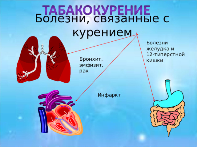 Болезни, связанные с курением Болезни желудка и 12-типерстной кишки Бронхит, эмфизит, рак Инфаркт 