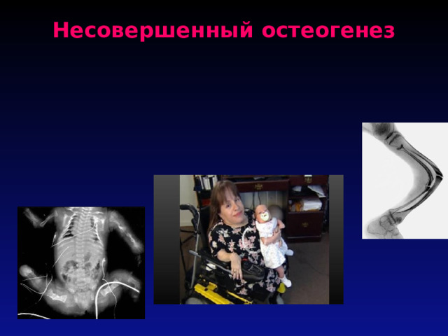 Несовершенный остеогенез   