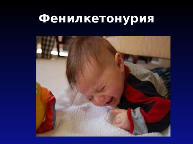 Фенилкетонурия 