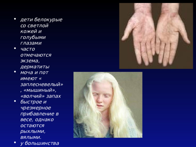 дети белокурые со светлой кожей и голубыми глазами часто отмечаются экзема, дерматиты моча и пот имеют « заплесневелый», «мышиный», «волчий» запах быстрое и чрезмерное прибавление в весе, однако остаются рыхлыми, вялыми. у большинства рано зарастает большой родничок 