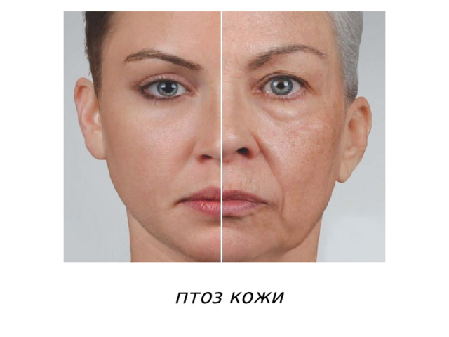 птоз кожи 