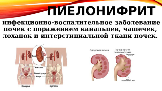 ПИЕЛОНИФРИТ  инфекционно‑воспалительное заболевание почек с поражением канальцев, чашечек, лоханок и интерстициальной ткани почек. 