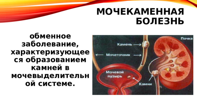 Мочекаменная болезнь обменное заболевание, характеризующееся образованием камней в мочевыделительной системе. 