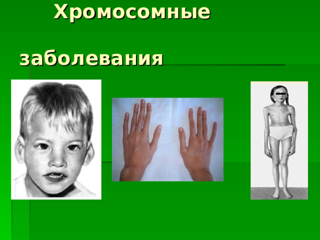  Хромосомные  заболевания 