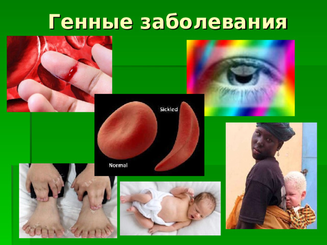  Генные заболевания 