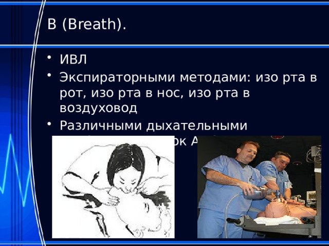В (Breath). ИВЛ Экспираторными методами: изо рта в рот, изо рта в нос, изо рта в воздуховод Различными дыхательными приборами: мешок Амбу, аппараты ИВЛ 