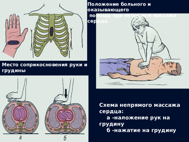 Положение больного и оказывающего   помощь при непрямом массаже сердца. Место соприкосновения руки и грудины               Схема непрямого массажа сердца:      а -наложение рук на грудину      б -нажатие на грудину 