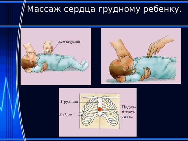 Массаж сердца грудному ребенку.   