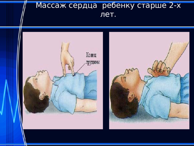 Массаж сердца ребенку старше 2-х лет.   