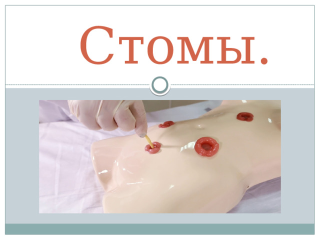 Стомы. 