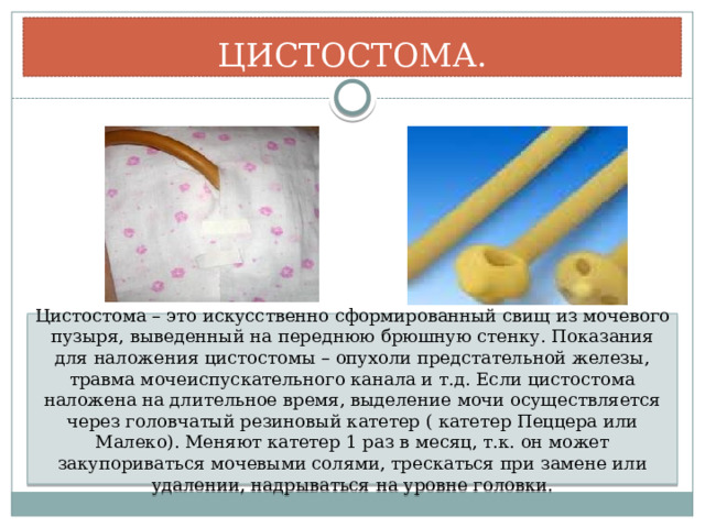 ЦИСТОСТОМА. Цистостома – это искусственно сформированный свищ из мочевого пузыря, выведенный на переднюю брюшную стенку. Показания для наложения цистостомы – опухоли предстательной железы, травма мочеиспускательного канала и т.д. Если цистостома наложена на длительное время, выделение мочи осуществляется через головчатый резиновый катетер ( катетер Пеццера или Малеко). Меняют катетер 1 раз в месяц, т.к. он может закупориваться мочевыми солями, трескаться при замене или удалении, надрываться на уровне головки. 