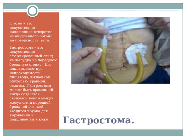 С тома – это искусственно наложенное отверстие из внутреннего органа на поверхность тела. Гастростома – это искусственно сформированный свищ из желудка на переднюю брюшную стенку. Его накладывают при непроходимости пищевода, вызванной опухолью, травмой, ожогом. Гастростома может быть временной, когда создается свищевой канал между желудком и передней брюшной стенкой, вводится трубка для кормления и подшивается к коже.  Гастростома. 