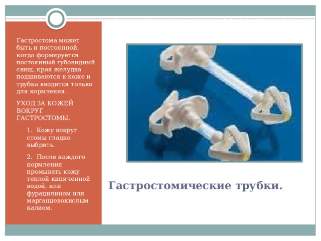 Гастростома может быть и постоянной, когда формируется постоянный губовидный свищ, края желудка подшиваются к коже и трубка вводится только для кормления. УХОД ЗА КОЖЕЙ ВОКРУГ ГАСТРОСТОМЫ. 1. Кожу вокруг стомы гладко выбрить. 2. После каждого кормления промывать кожу теплой кипяченной водой, или фурацилином или марганцевокислым калием. Гастростомические трубки. 