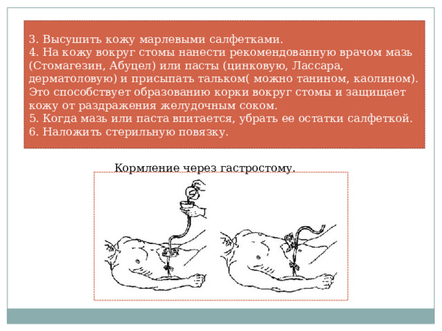 3. Высушить кожу марлевыми салфетками. 4. На кожу вокруг стомы нанести рекомендованную врачом мазь (Стомагезин, Абуцел) или пасты (цинковую, Лассара, дерматоловую) и присыпать тальком( можно танином, каолином). Это способствует образованию корки вокруг стомы и защищает кожу от раздражения желудочным соком. 5. Когда мазь или паста впитается, убрать ее остатки салфеткой. 6. Наложить стерильную повязку. Кормление через гастростому. 