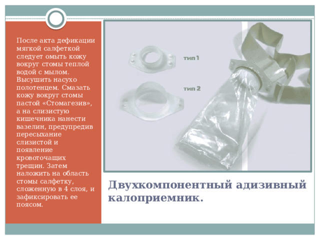 После акта дефикации мягкой салфеткой следует омыть кожу вокруг стомы теплой водой с мылом. Высушить насухо полотенцем. Смазать кожу вокруг стомы пастой «Стомагезив», а на слизистую кишечника нанести вазелин, предупредив пересыхание слизистой и появление кровоточащих трещин. Затем наложить на область стомы салфетку, сложенную в 4 слоя, и зафиксировать ее поясом. Двухкомпонентный адизивный калоприемник. 