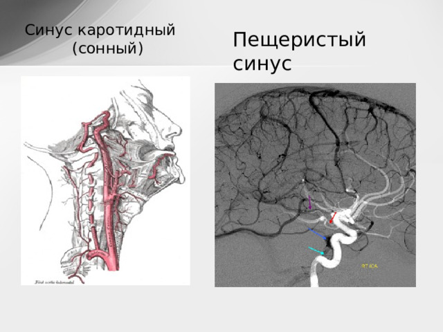 Синус каротидный (сонный) Пещеристый синус 