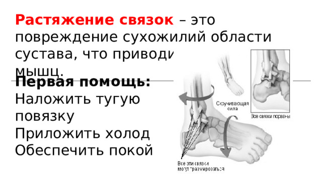 Растяжение связок – это повреждение сухожилий области сустава, что приводит к разрыву мышц. Первая помощь: Наложить тугую повязку Приложить холод Обеспечить покой 
