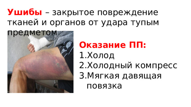 Ушибы  –  закрытое повреждение тканей и органов от удара тупым предметом Оказание ПП: 1.Холод 2.Холодный компресс 3.Мягкая давящая повязка 