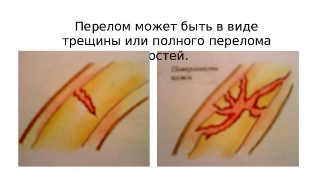  Перелом может быть в виде трещины или полного перелома костей. Осколочный 