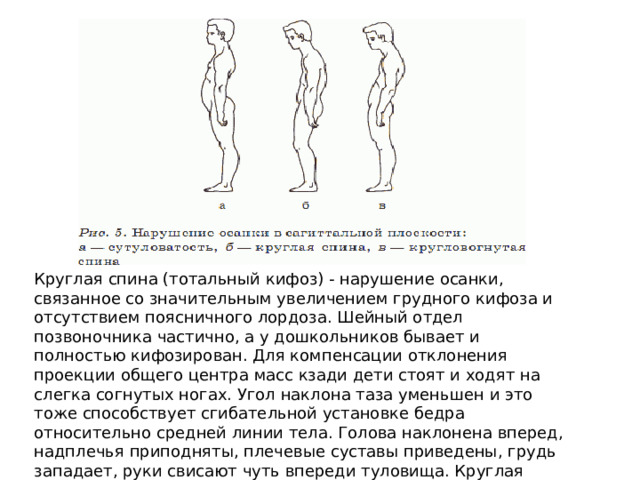 Круглая спина (тотальный кифоз) - нарушение осанки, связанное со значительным увеличением грудного кифоза и отсутствием поясничного лордоза. Шейный отдел позвоночника частично, а у дошкольников бывает и полностью кифозирован. Для компенсации отклонения проекции общего центра масс кзади дети стоят и ходят на слегка согнутых ногах. Угол наклона таза уменьшен и это тоже способствует сгибательной установке бедра относительно средней линии тела. Голова наклонена вперед, надплечья приподняты, плечевые суставы приведены, грудь западает, руки свисают чуть впереди туловища. Круглая спина часто сочетается с крыловидными лопатками 2 степени. 