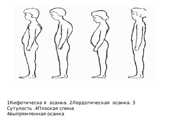 1Кифотическа я осанка. 2Лордотическая осанка. 3 Сутулость .4Плоская спина 4выпрямленная осанка 