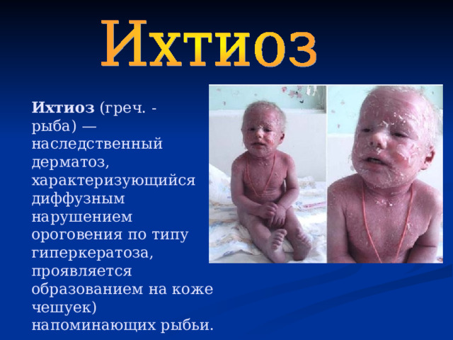 Ихтиоз (греч. - рыба) — наследственный дерматоз, характеризующийся диффузным нарушением ороговения по типу гиперкератоза, проявляется образованием на коже чешуек) напоминающих рыбьи. 