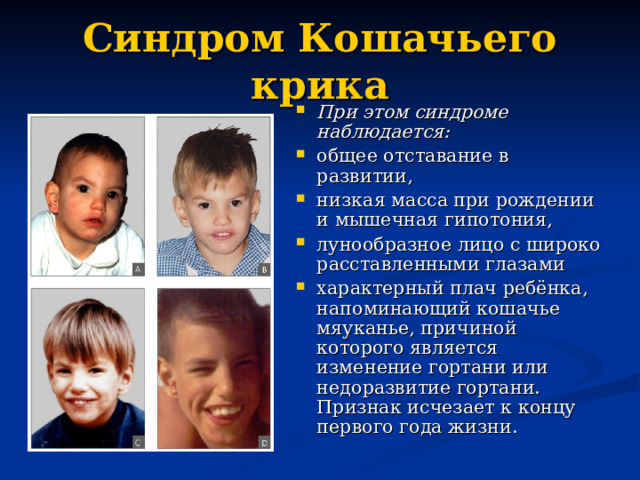 Синдром Кошачьего крика При этом синдроме наблюдается: общее отставание в развитии, низкая масса при рождении и мышечная гипотония, лунообразное лицо с широко расставленными глазами характерный плач ребёнка, напоминающий кошачье мяуканье, причиной которого является изменение гортани или недоразвитие гортани. Признак исчезает к концу первого года жизни.  