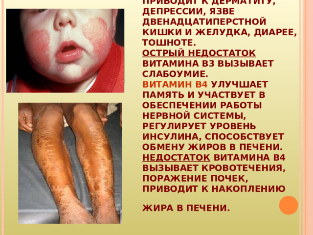 ВИТАМИН B3  УЧАСТВУЕТ В РАБОТЕ НАДПОЧЕЧНИКОВ, НЕРВНОЙ И КРОВЕНОСНОЙ СИСТЕМ.  ДЕФИЦИТ ВИТАМИНА В3 ПРИВОДИТ К ДЕРМАТИТУ, ДЕПРЕССИИ, ЯЗВЕ ДВЕНАДЦАТИПЕРСТНОЙ КИШКИ И ЖЕЛУДКА, ДИАРЕЕ, ТОШНОТЕ.  ОСТРЫЙ НЕДОСТАТОК ВИТАМИНА B3 ВЫЗЫВАЕТ СЛАБОУМИЕ.  ВИТАМИН B4  УЛУЧШАЕТ ПАМЯТЬ И УЧАСТВУЕТ В ОБЕСПЕЧЕНИИ РАБОТЫ НЕРВНОЙ СИСТЕМЫ, РЕГУЛИРУЕТ УРОВЕНЬ ИНСУЛИНА, СПОСОБСТВУЕТ ОБМЕНУ ЖИРОВ В ПЕЧЕНИ.  НЕДОСТАТОК ВИТАМИНА B4 ВЫЗЫВАЕТ КРОВОТЕЧЕНИЯ, ПОРАЖЕНИЕ ПОЧЕК, ПРИВОДИТ К НАКОПЛЕНИЮ ЖИРА В ПЕЧЕНИ.  