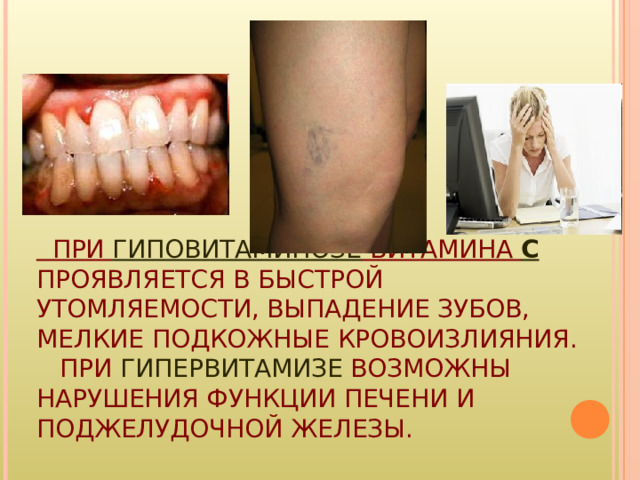 ПРИ ГИПОВИТАМИНОЗЕ ВИТАМИНА С  ПРОЯВЛЯЕТСЯ В БЫСТРОЙ УТОМЛЯЕМОСТИ, ВЫПАДЕНИЕ ЗУБОВ, МЕЛКИЕ ПОДКОЖНЫЕ КРОВОИЗЛИЯНИЯ.  ПРИ ГИПЕРВИТАМИЗЕ ВОЗМОЖНЫ НАРУШЕНИЯ ФУНКЦИИ ПЕЧЕНИ И ПОДЖЕЛУДОЧНОЙ ЖЕЛЕЗЫ. 