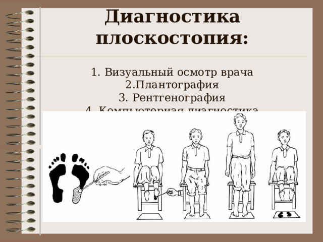   Диагностика плоскостопия:   1. Визуальный осмотр врача  2.Плантография  3. Рентгенография  4, Компьютерная диагностика   