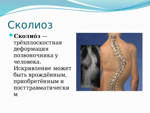 Сколиоз Сколио́з  — трёхплоскостная деформация позвоночника у человека. Искривление может быть врождённым, приобретённым и посттравматическим 