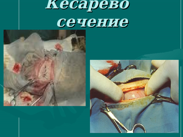 Кесарево сечение 