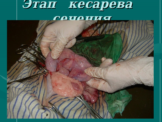 Этап кесарева сечения 