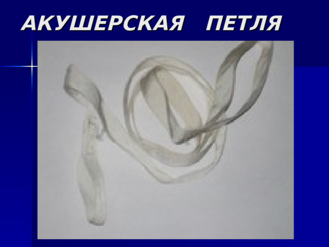 АКУШЕРСКАЯ ПЕТЛЯ 