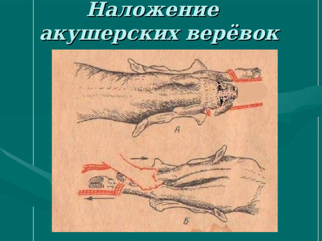 Наложение акушерских верёвок 