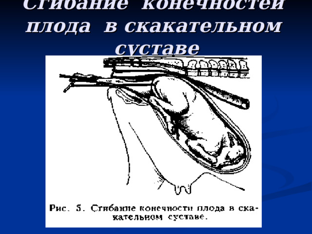 Сгибание конечностей плода в скакательном суставе 