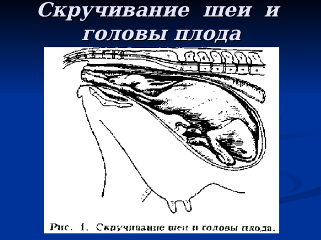 Скручивание шеи и головы плода 