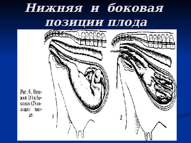 Нижняя и боковая позиции плода 