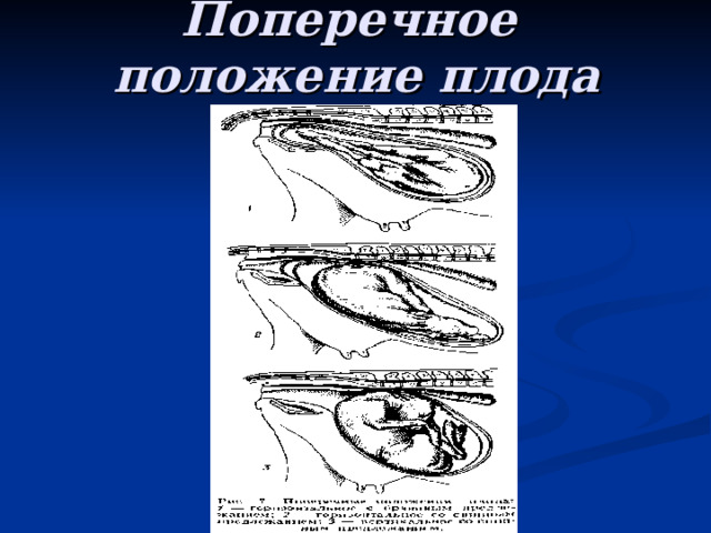 Поперечное положение плода 