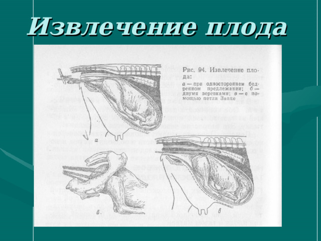 Извлечение плода 