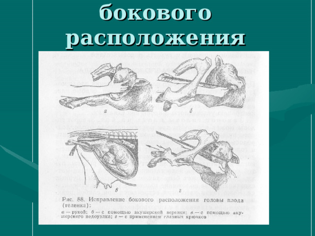 Исправление бокового расположения головы плода 