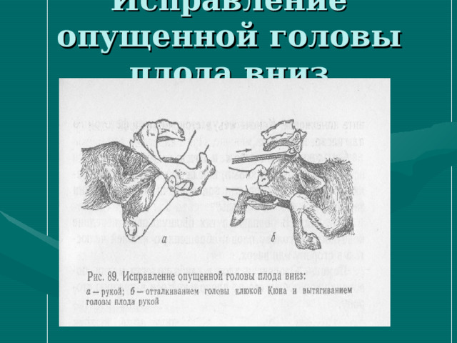 Исправление опущенной головы плода вниз 