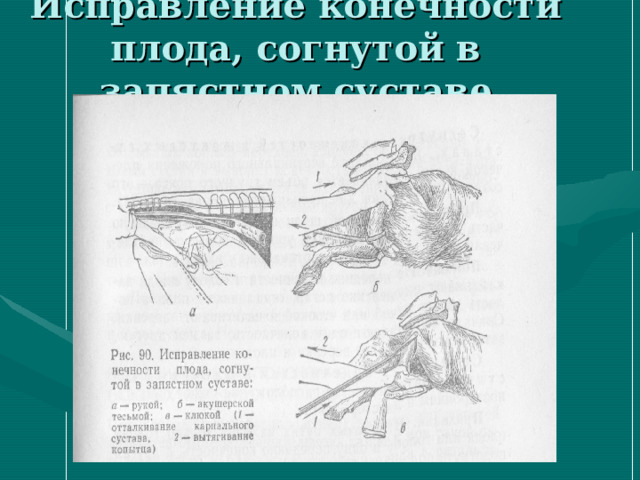 Исправление конечности плода, согнутой в запястном суставе 