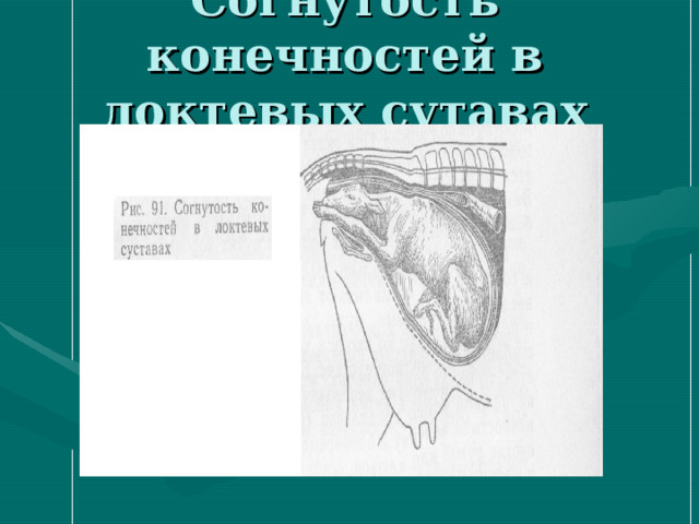Согнутость конечностей в локтевых сутавах 