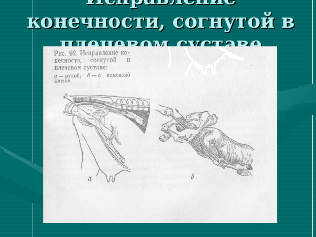 Исправление конечности, согнутой в плечевом суставе 