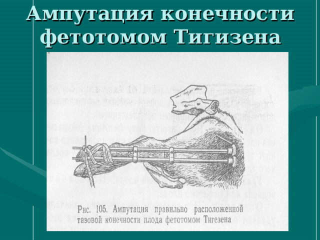 Ампутация конечности фетотомом Тигизена 